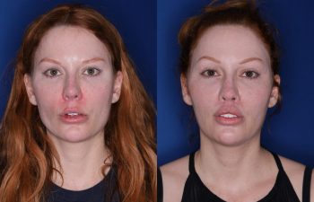 33 year old female 2 months following revision lip lift with a perialar lip lift