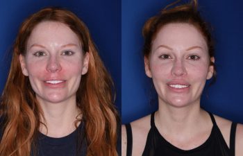 33 year old female 2 months following revision lip lift with a perialar lip lift