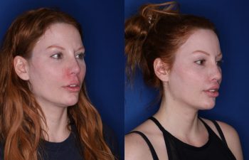 33 year old female 2 months following revision lip lift with a perialar lip lift