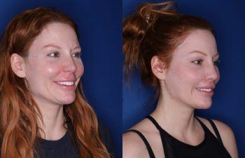 33 year old female 2 months following revision lip lift with a perialar lip lift