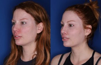 33 year old female 2 months following revision lip lift with a perialar lip lift