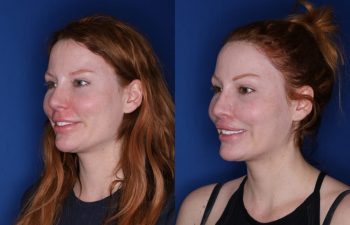 33 year old female 2 months following revision lip lift with a perialar lip lift