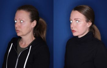 52 year old 8 months post op from an extended deep plane facelift/necklift, buccal fat reduction, and upper and lower blepharoplasty
