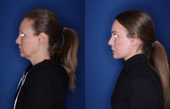 52 year old 8 months post op from an extended deep plane facelift/necklift, buccal fat reduction, and upper and lower blepharoplasty