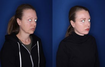 52 year old 8 months post op from an extended deep plane facelift/necklift, buccal fat reduction, and upper and lower blepharoplasty