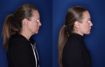 52 year old 8 months post op from an extended deep plane facelift/necklift, buccal fat reduction, and upper and lower blepharoplasty