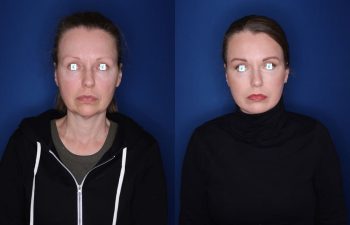 52 year old 8 months post op from an extended deep plane facelift/necklift, buccal fat reduction, and upper and lower blepharoplasty