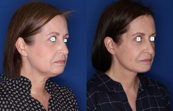 60 year old female 6 months post op from Extended Deep Plane Facelift, Platysmaplasty, Upper Blepharoplasty, Lateral Temporal Browlift, and Buccal Fat Pad Removal.
