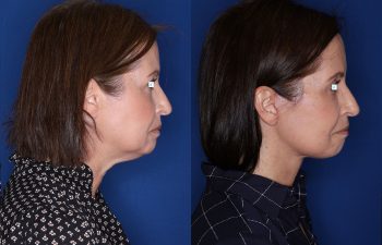 60 year old female 6 months post op from Extended Deep Plane Facelift, Platysmaplasty, Upper Blepharoplasty, Lateral Temporal Browlift, and Buccal Fat Pad Removal.