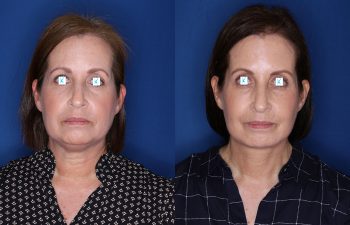 60 year old female 6 months post op from Extended Deep Plane Facelift, Platysmaplasty, Upper Blepharoplasty, Lateral Temporal Browlift, and Buccal Fat Pad Removal.