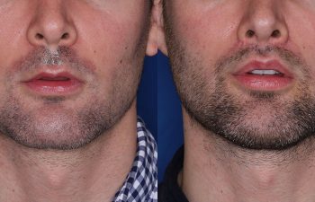 30 year old male 4 months post op from perialar lip lift