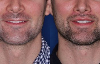 30 year old male 4 months post op from perialar lip lift