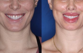 38 year old female one month post op from upper perialar lip lift and lower v to y lip augmentation.