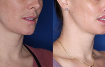 38 year old female one month post op from upper perialar lip lift and lower v to y lip augmentation.