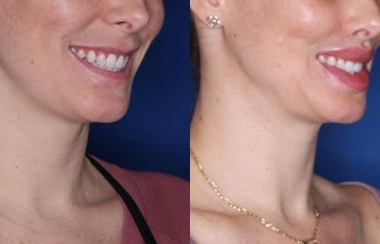 38 year old female one month post op from upper perialar lip lift and lower v to y lip augmentation.