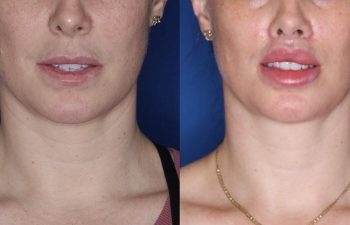 38 year old female one month post op from upper perialar lip lift and lower v to y lip augmentation.