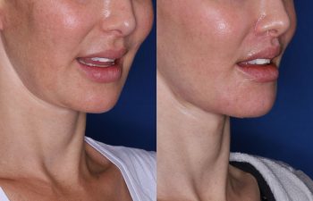 before and after photos following the lip lift procedure