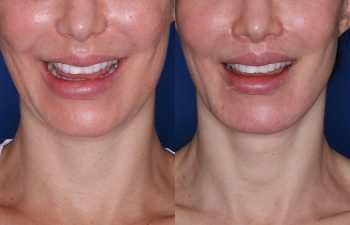 before and after photos following the lip lift procedure