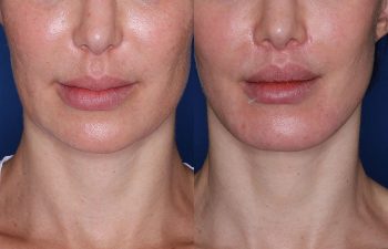 before and after photos following the lip lift procedure
