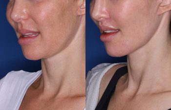 before and after photos following the lip lift procedure