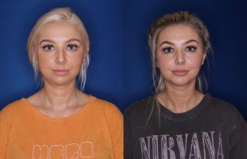 26 year old female 4 months post op from chin implant.