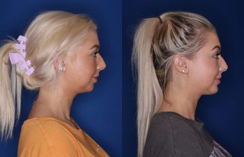 26 year old female 4 months post op from chin implant.