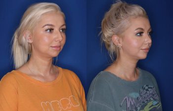 26 year old female 1 month post op from cosmetic rhinoplasty and 6 months post op from chin implant.