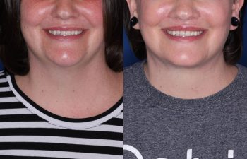 37 year old female 4 months post op from Perialar Lip Lift.