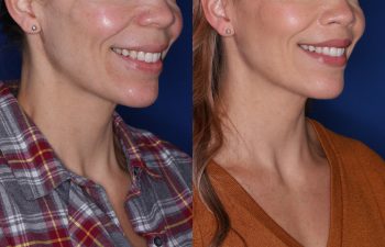 44 year old female 23 months post op from Perialar Lip Lift