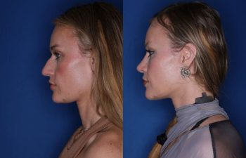35 year old female patient 3 months post-op from a Rhinoplasty