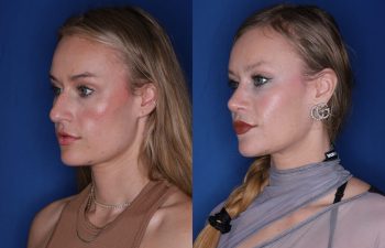 35 year old female patient 3 months post-op from a Rhinoplasty