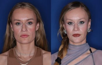 35 year old female patient 3 months post-op from a Rhinoplasty