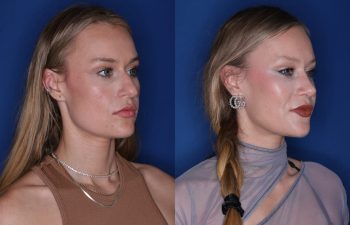 35 year old female patient 3 months post-op from a Rhinoplasty