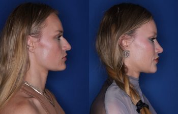 35 year old female patient 3 months post-op from a Rhinoplasty