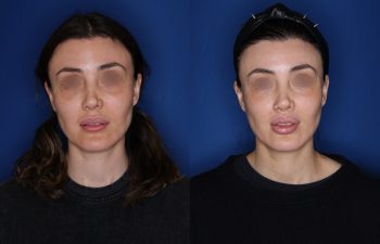 40 year old female patient 6 months post-op from a Revision Perialar Lip Lift and V to Y lower Lip Augmentation.
