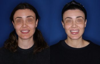 40 year old female patient 6 months post-op from a Revision Perialar Lip Lift and V to Y lower Lip Augmentation.