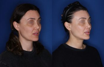 40 year old female patient 6 months post-op from a Revision Perialar Lip Lift and V to Y lower Lip Augmentation.