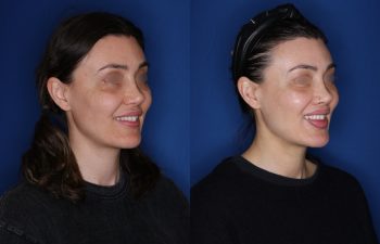 40 year old female patient 6 months post-op from a Revision Perialar Lip Lift and V to Y lower Lip Augmentation.