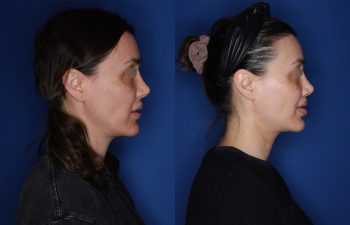 40 year old female patient 6 months post-op from a Revision Perialar Lip Lift and V to Y lower Lip Augmentation.