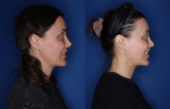 40 year old female patient 6 months post-op from a Revision Perialar Lip Lift and V to Y lower Lip Augmentation.