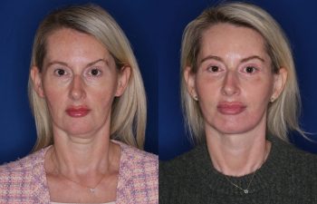 50 year old female patient 6 months post-op from KalosLift (mini extended deep plane) facelift, upper blepharoplasty, and fat transposition lower blepharoplasty.
