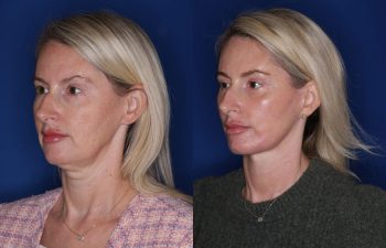50 year old female patient 6 months post-op from KalosLift (mini extended deep plane) facelift, upper blepharoplasty, and fat transposition lower blepharoplasty.