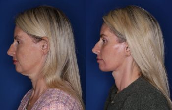 50 year old female patient 6 months post-op from KalosLift (mini extended deep plane) facelift, upper blepharoplasty, and fat transposition lower blepharoplasty.