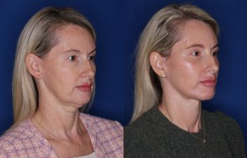 50 year old female patient 6 months post-op from KalosLift (mini extended deep plane) facelift, upper blepharoplasty, and fat transposition lower blepharoplasty.