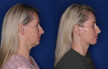 50 year old female patient 6 months post-op from KalosLift (mini extended deep plane) facelift, upper blepharoplasty, and fat transposition lower blepharoplasty.