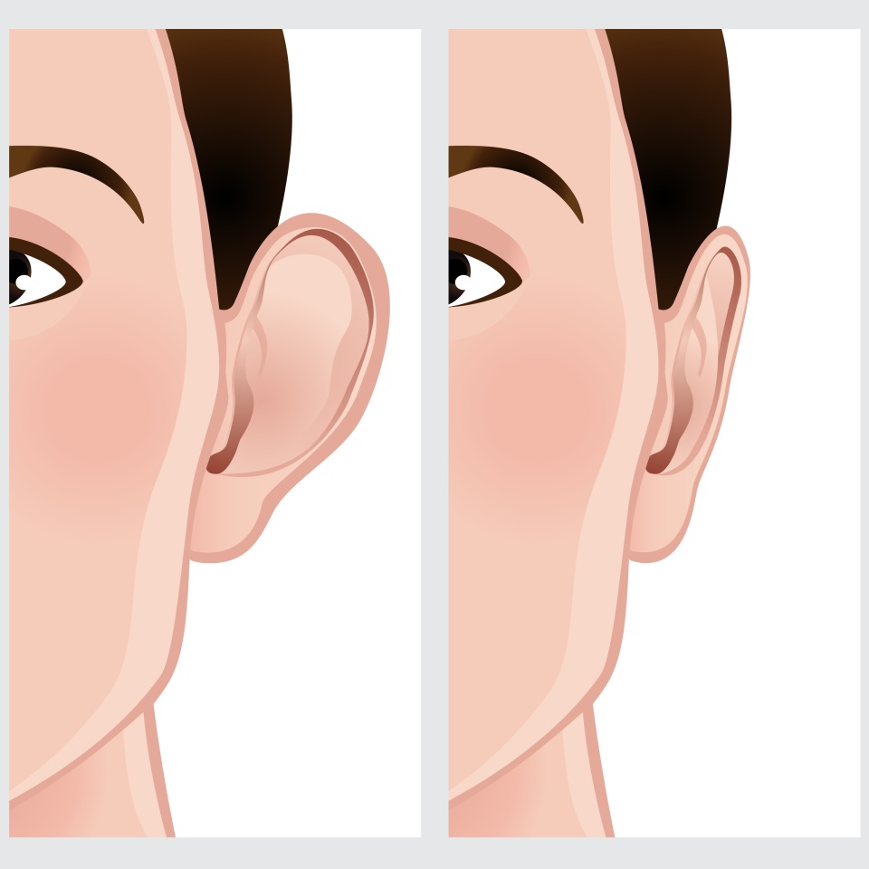 Ear pinning, Otoplasty.