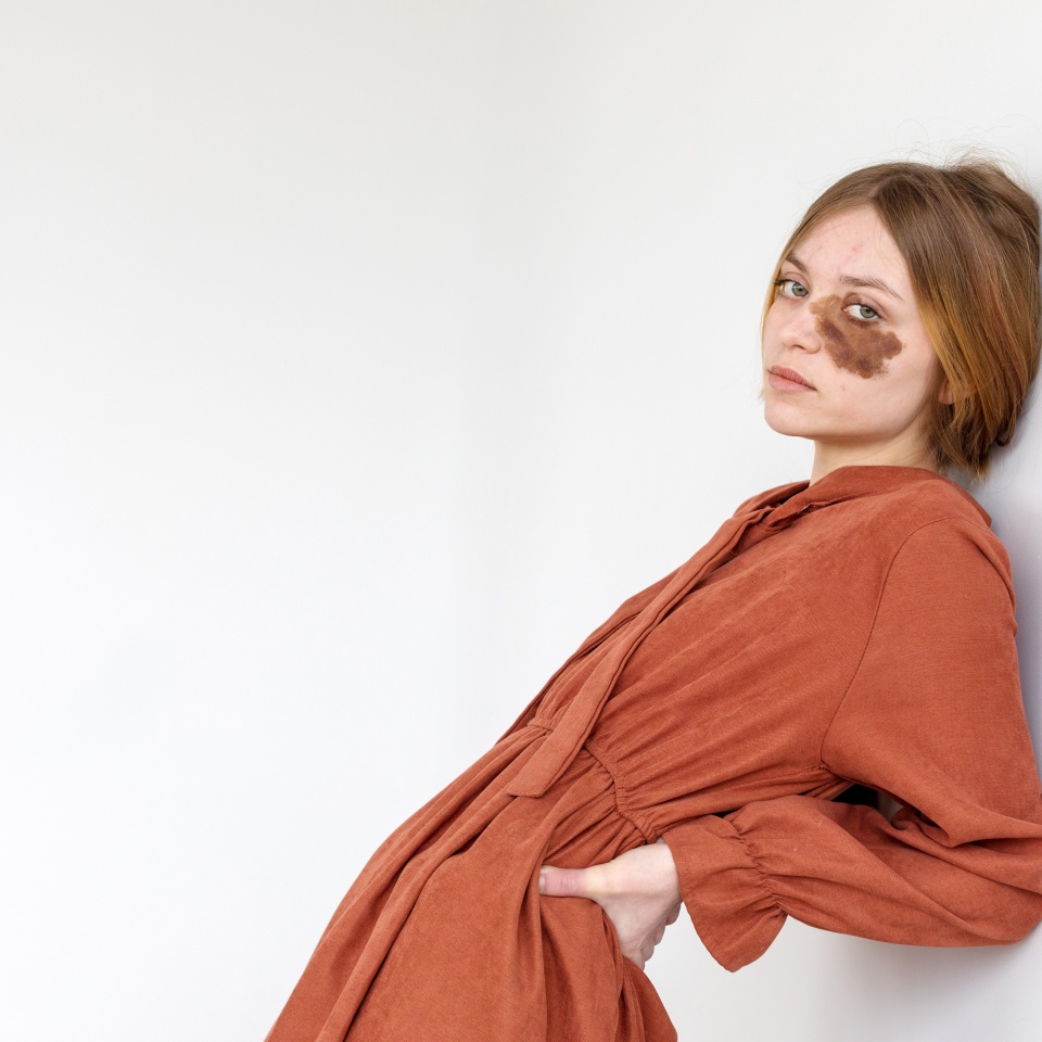 Side view of young woman in brown wear with birthmark on cheek looking at camera with hand on hip