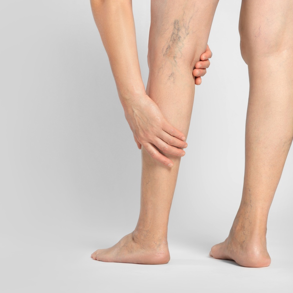 Closeup view of woman suffering from varicose veins on light background. Space for text