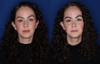 41 year old female 2 months post rhinoplasty