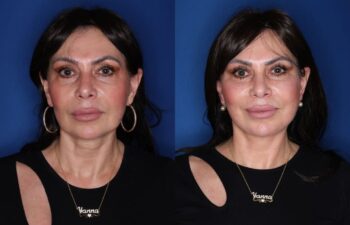 Before and 3-months-after photos of a 59-year-old female patient following KalosLift extended deep plane facelift with platysmaplasty neck lift.